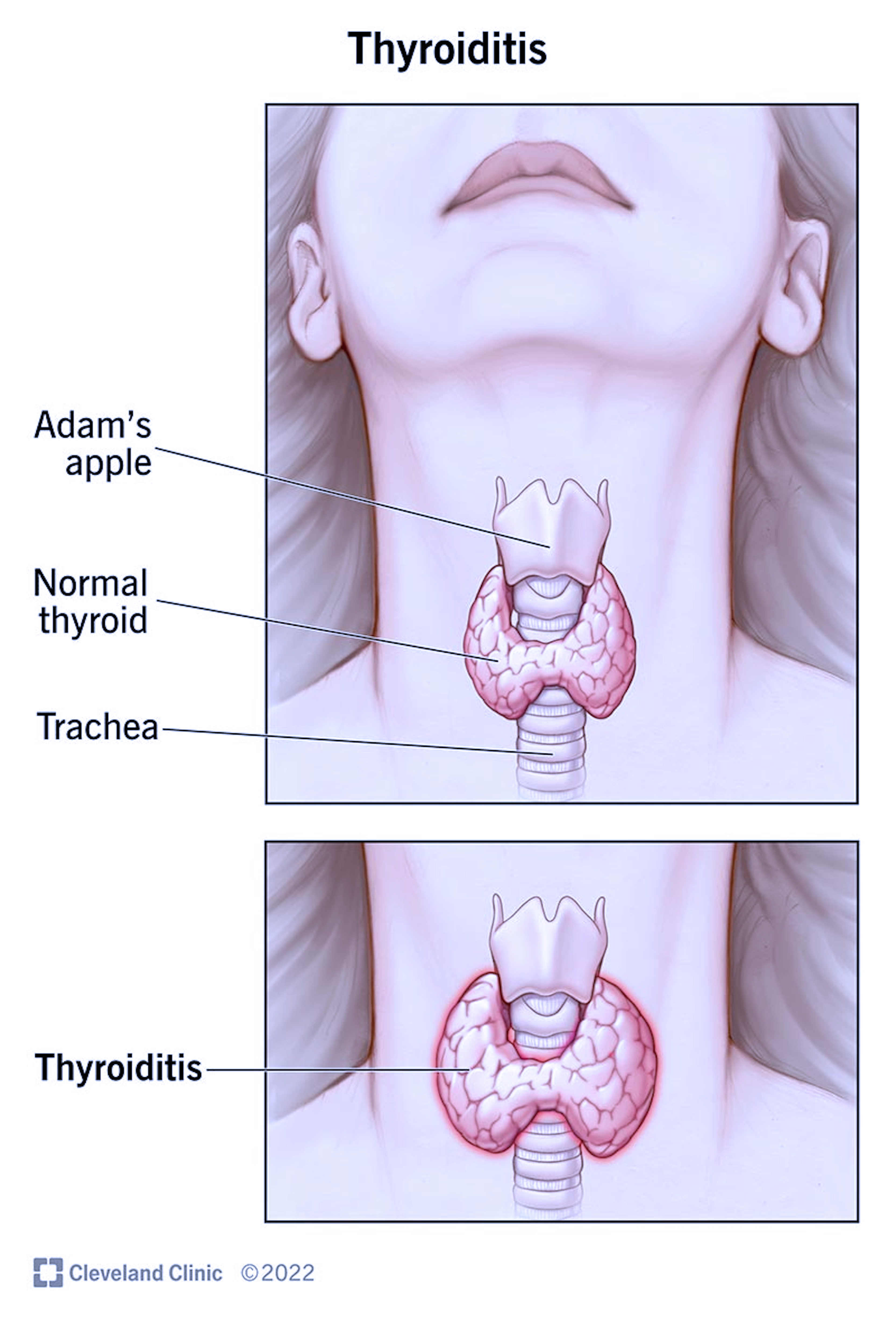 Thyroid gland inside the human body.